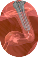 Illustration representing embryo transfer procedure