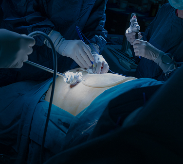 Laparoscopy