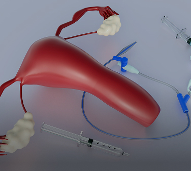 Hysterosalpingogram (HSG)