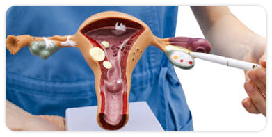 Illustration representing ovarian stimulation during ICSI treatment